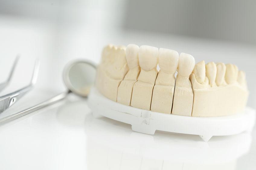 Dolna szczęka człowieka, wykonana z gipsu. Cześć zębów jest normalna i nieatrakcyjna. A na pozostałe, nałożone są licówki, upiększające uśmiech.