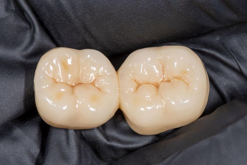 Widok dwóch zębów, pokazujący górną część zęba.